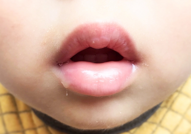 口呼吸が歯並びに悪影響を与える理由