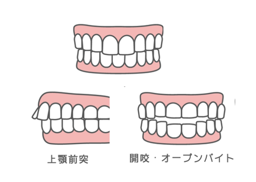 指しゃぶりが歯並びに与える影響と対策